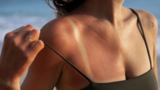 Saiba quais os tipos de radiação UV e os principais danos provocados à pele